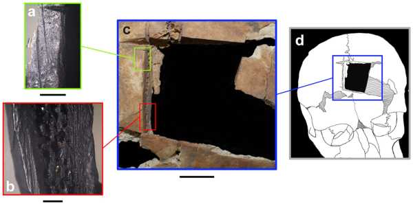 Ισραήλ: Βρέθηκε κρανίο με τετράγωνη τρύπα – Ένδειξη για χειρουργική εγκεφάλου πριν 3.500 χρόνια