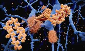 Αλτσχάιμερ: Ενθαρρυντικά τα αποτελέσματα της πρώτης θεραπείας γονιδιακής σίγασης