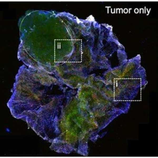 Ερευνητές ανέπτυξαν φορητό τρισδιάστατο βιοεκτυπωτή για την έρευνα του καρκίνου